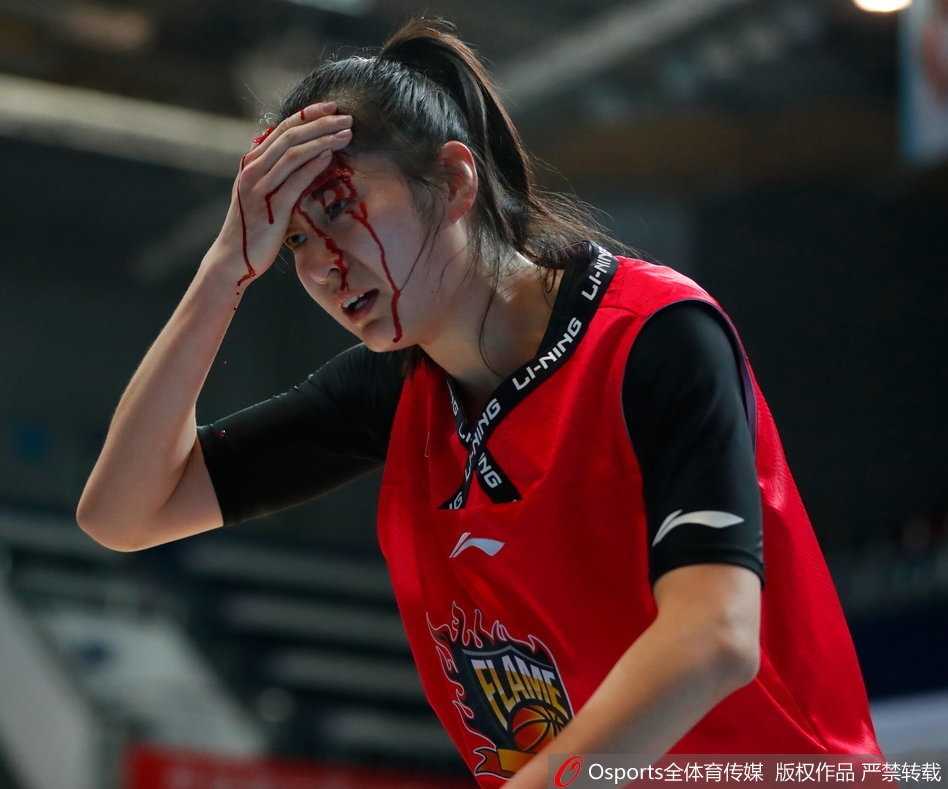 赛场铁血玫瑰:山西女篮郭子瑄头部重创血流满面仍昂首离场 经过简单包扎后,郭子瑄的头部缠上了厚厚的纱布,但纱布很快又被渗出的鲜血染红,伤情触目惊心。